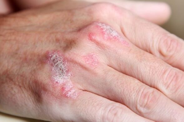 symptômes du psoriasis sur les mains