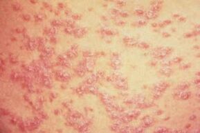 taches rouges sur la peau avec psoriasis