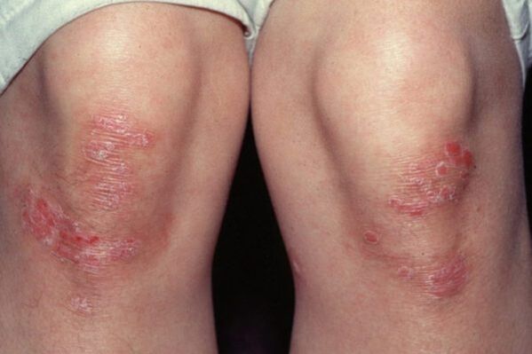 psoriasis sur les genoux