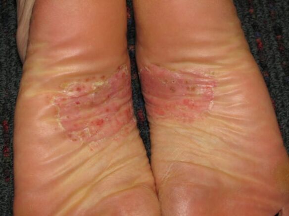 psoriasis sur les pieds