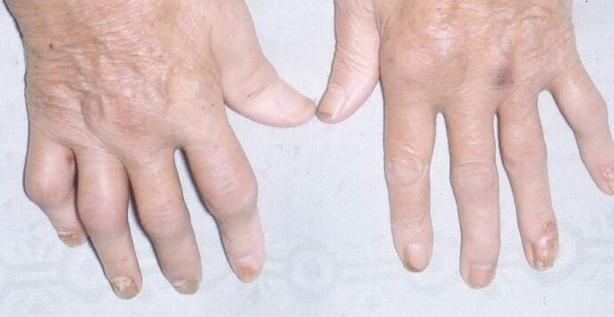 psoriasis arthropathique sur les mains