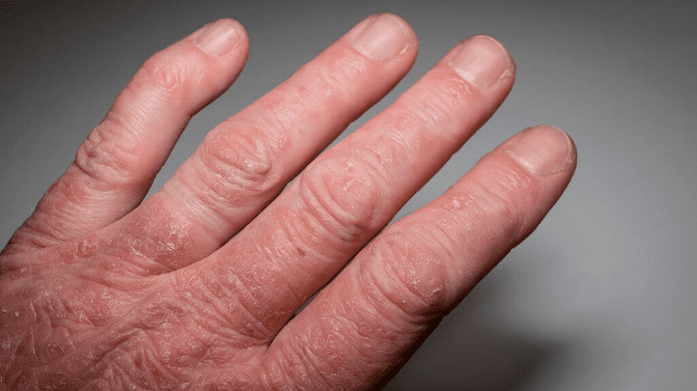 rhumatisme psoriasique sur les mains