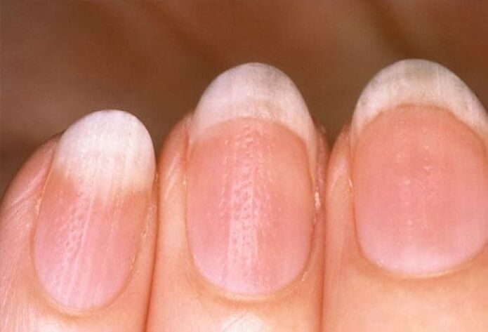 psoriasis sur les ongles