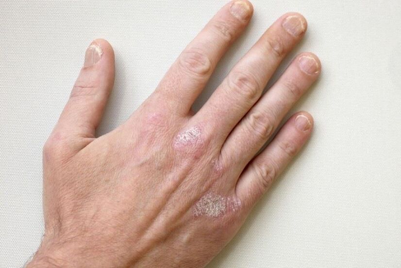 Un symptôme obligatoire du psoriasis est la présence de plaques avec des squames sur la peau. 
