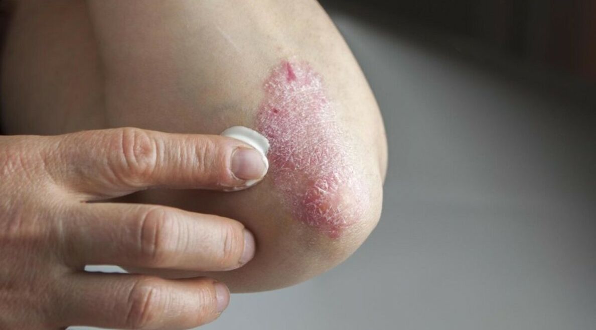 Psoriasis affectant la peau, dont le traitement comprend l'utilisation de pommades