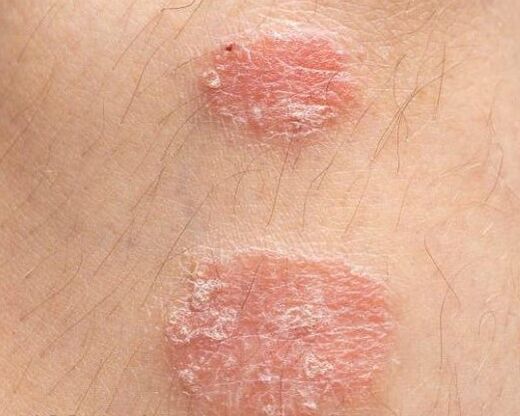 Apparence des plaques psoriasiques