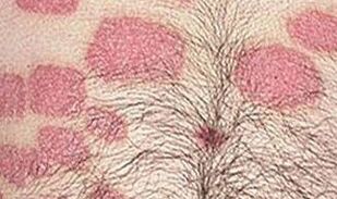 Plusieurs formations roses sur l'abdomen