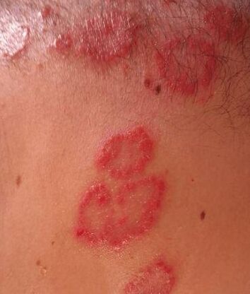 Spots psoriasis
