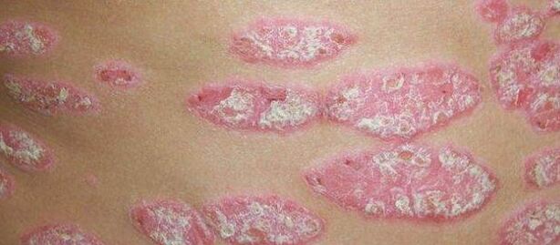 Le stade progressif du psoriasis