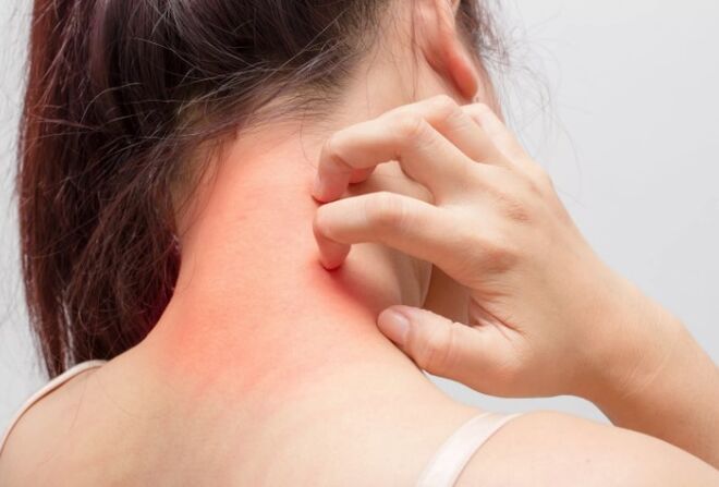 Les démangeaisons sont l'une des causes du psoriasis