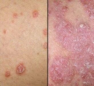 Plaques psoriatiques