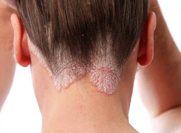 Érythrodermie psoriatique