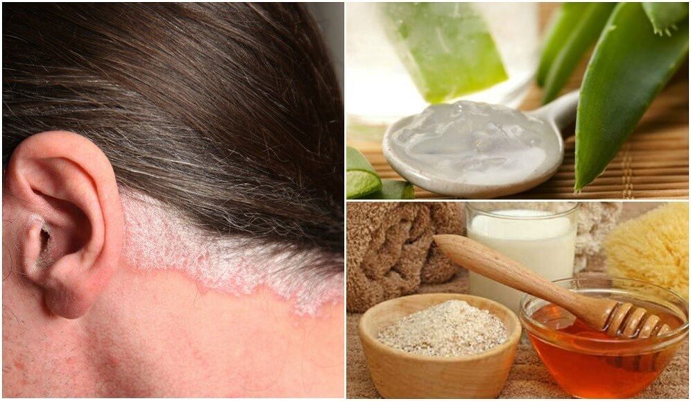 Traitement du psoriasis avec des remèdes populaires