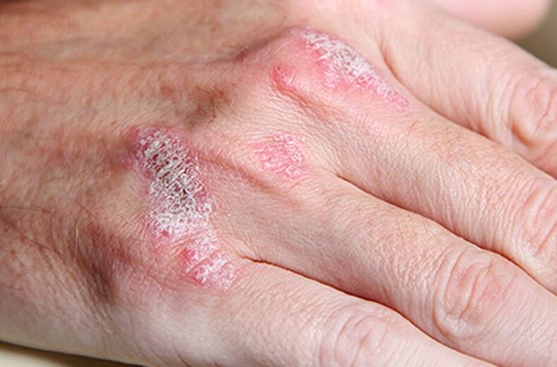 Psoriasis soutenu par la femme
