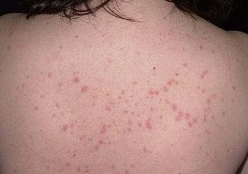 L'étape initiale du psoriasis