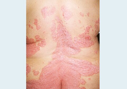 Psoriasis du dos