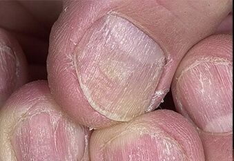 Psoriasis des ongles