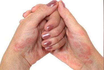 Psoriasis entre les mains