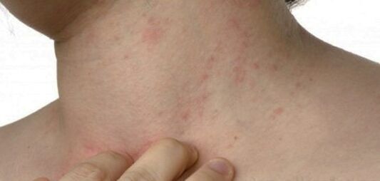 Psoriasis sur le cou