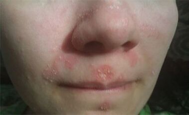 Psoriasis sur le visage