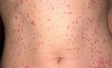 Psoriasis sur le corps