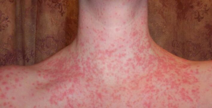 Psoriasis sur le corps