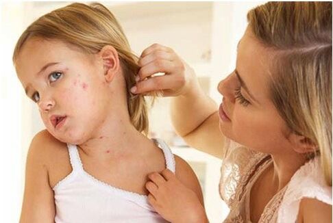Photo de l'étape initiale du psoriasis