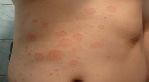 Psoriasis de l'étape initiale