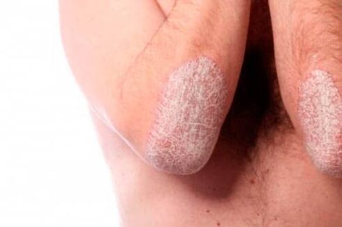 Psoriasis sur les coudes