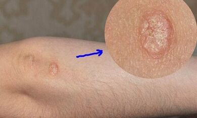 stades de développement du psoriasis