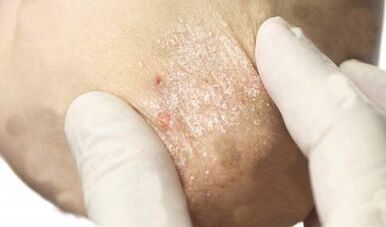 traitement du psoriasis au stade d'atténuation