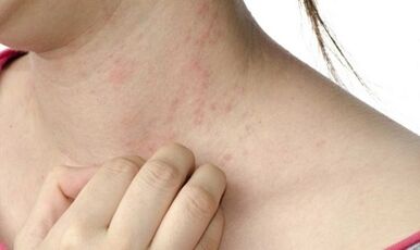 traitement du psoriasis à un stade avancé
