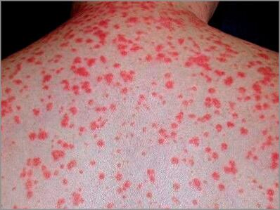 Psoriasis en gouttes