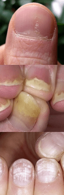 Psoriasis de clou - étape initiale