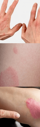 Psoriasis de l'étape initiale sur les mains
