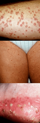 Psoriasis sur les jambes
