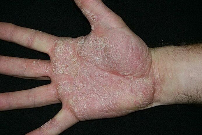 psoriasis des paumes et des pieds