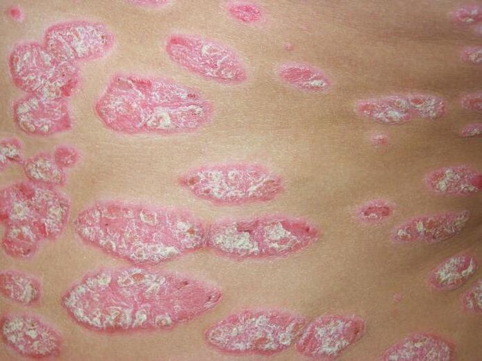 psoriasis en plaques