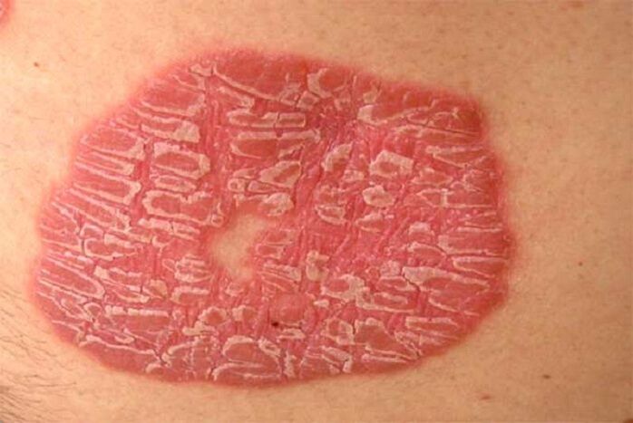 psoriasis pustuleux
