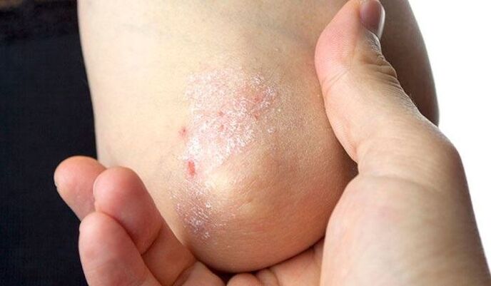 symptômes du psoriasis au stade initial