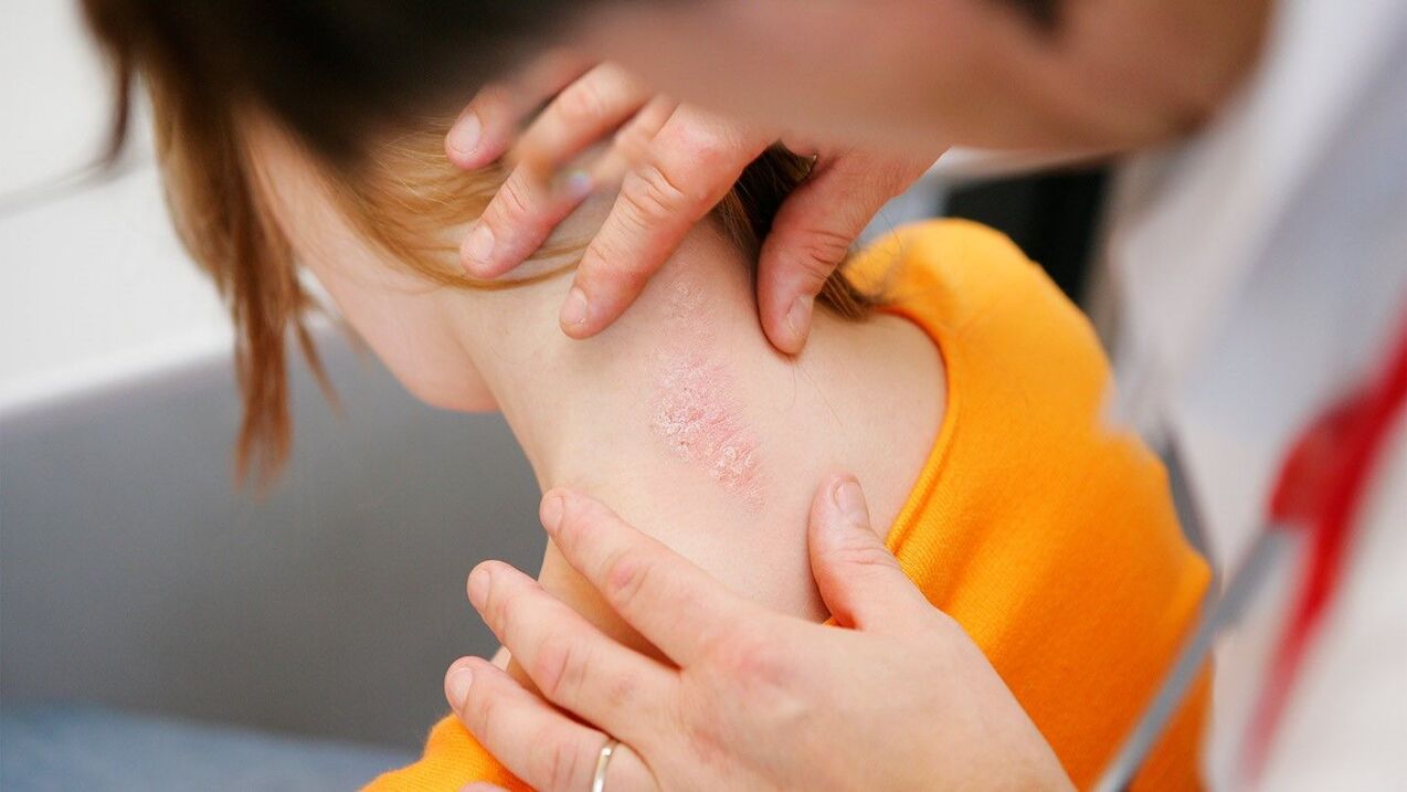 Symptômes du psoriasis