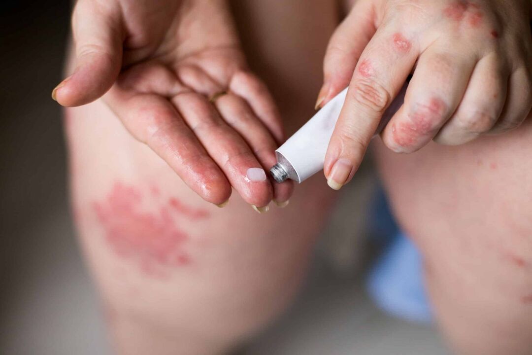 Traitement du psoriasis