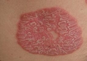 photos de psoriasis sur la peau
