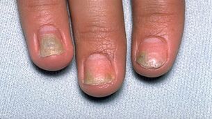 causes du psoriasis sur les ongles