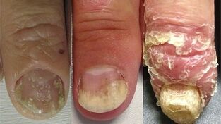 stades de développement du psoriasis des ongles